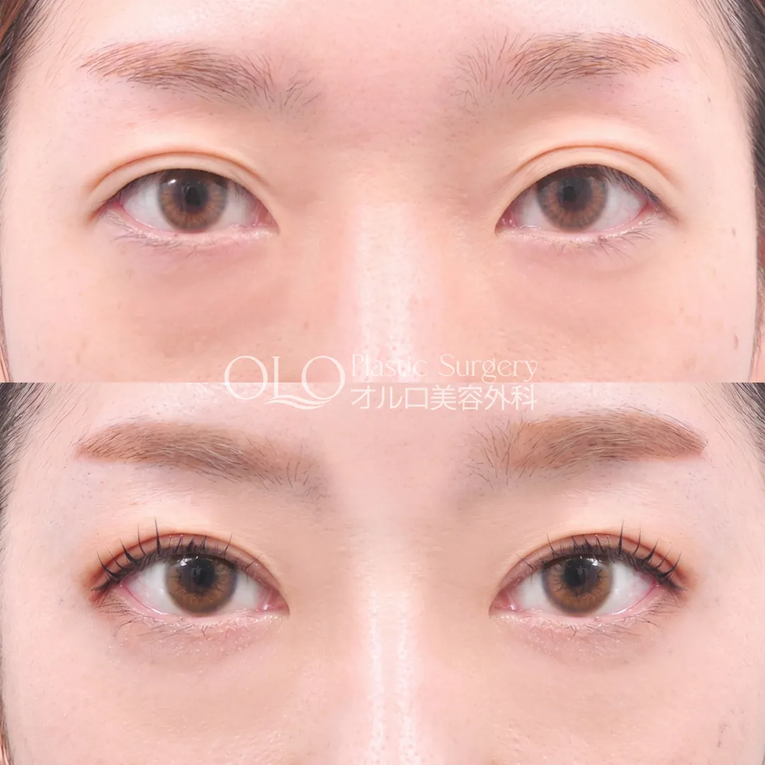 自然二重埋没（再手術）＋上眼瞼切開（目を大きく見せる上側の切開） の症例写真（Before / After）